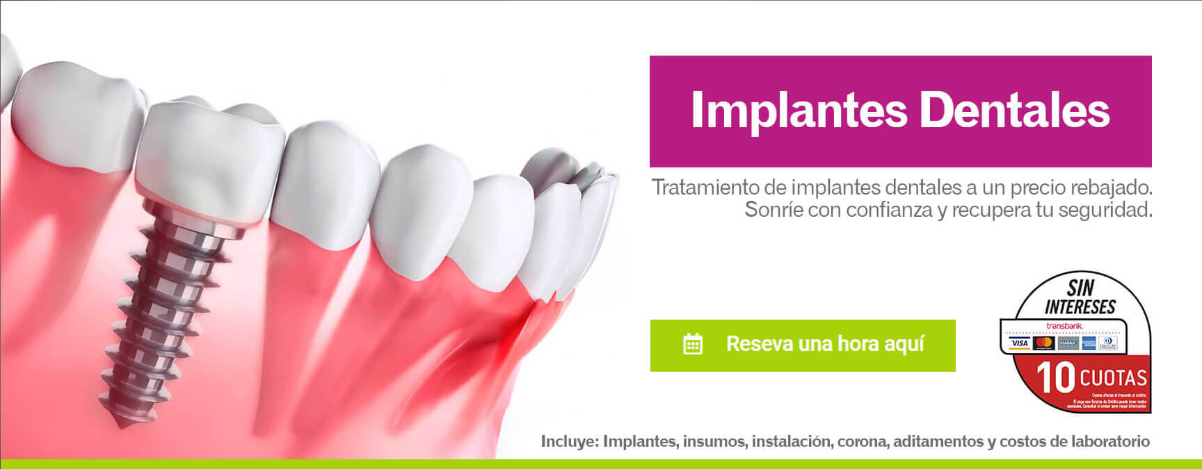 Implantes Dentales