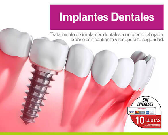 Implantes Dentales